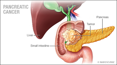 a-medical-illustration-of-pancreatic-cancer-original.jpg