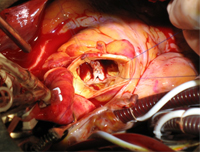 症 心臓 手術 弁膜 [41] 弁膜症とのつきあい方